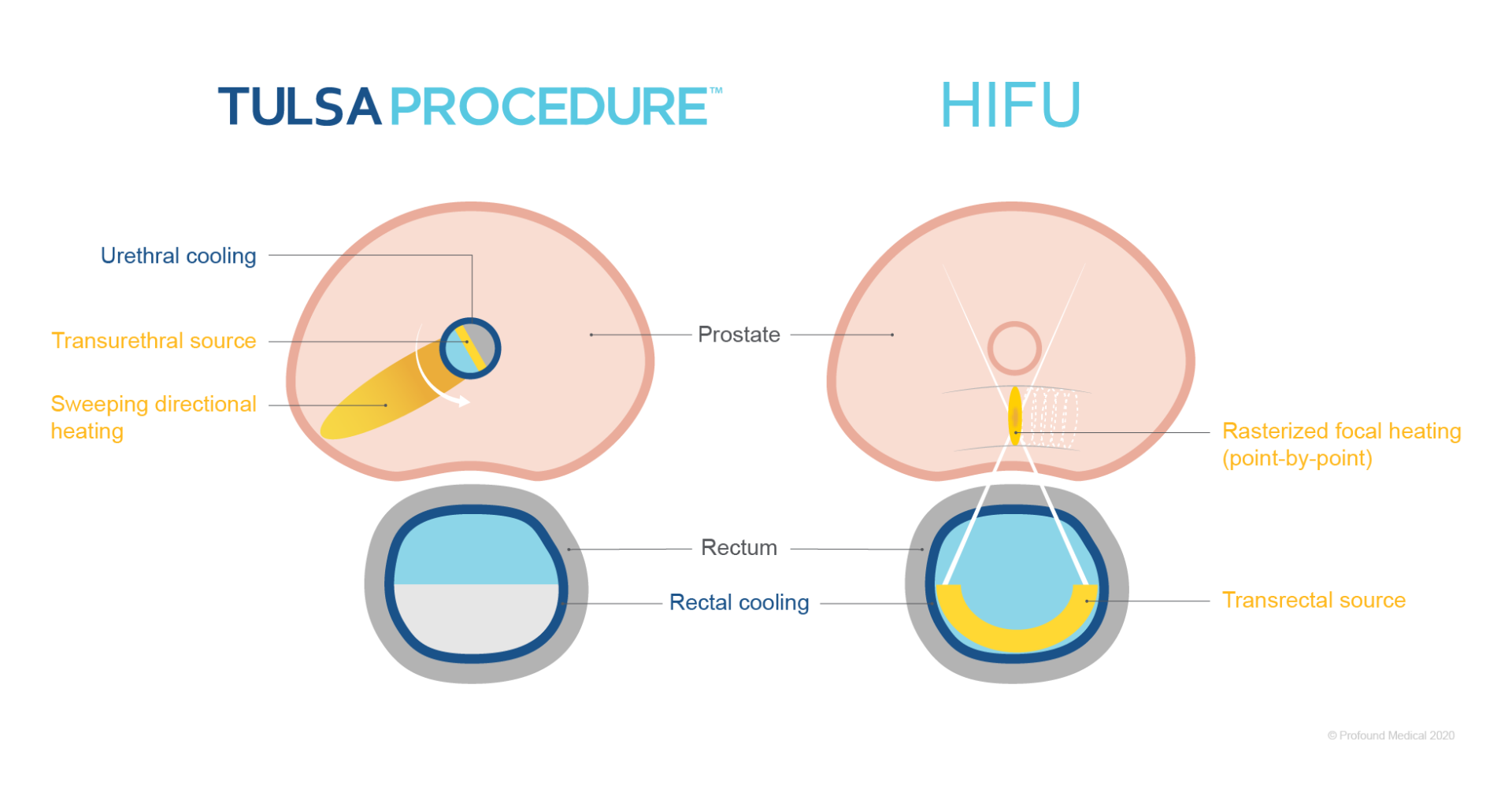 TULSA-Procedure-vs-HIFU-1920x1006.png