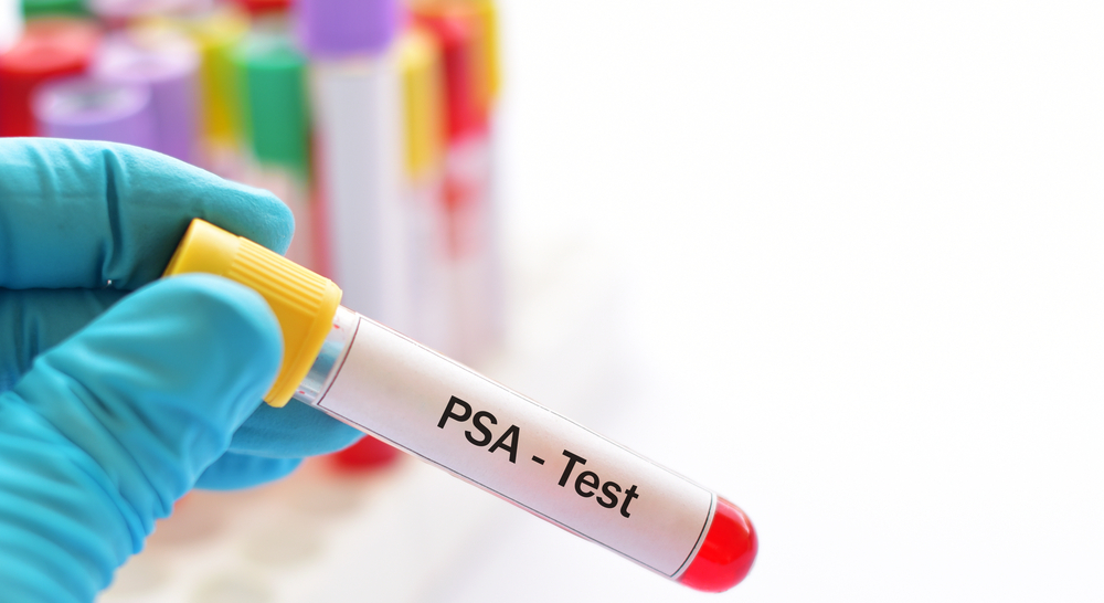 Prostate specific antigen psa test
