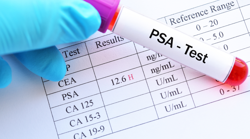 Psa testing and psa levels