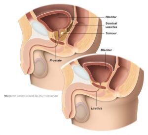 Prostate-diagram