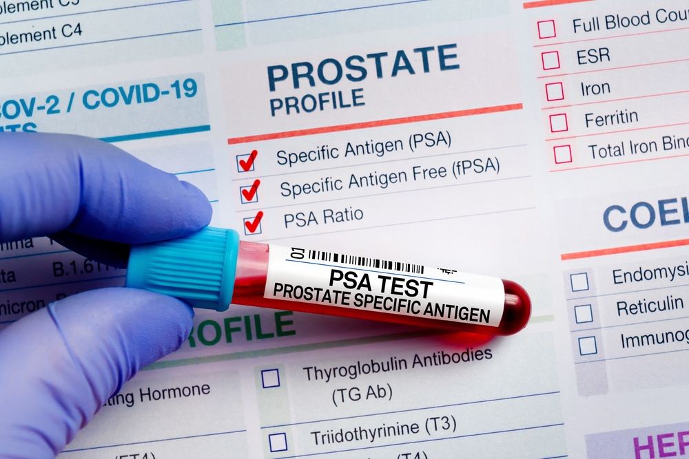 All About the Prostate-Specific Antigen Test